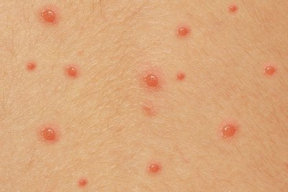 chicken pox pictures in adults