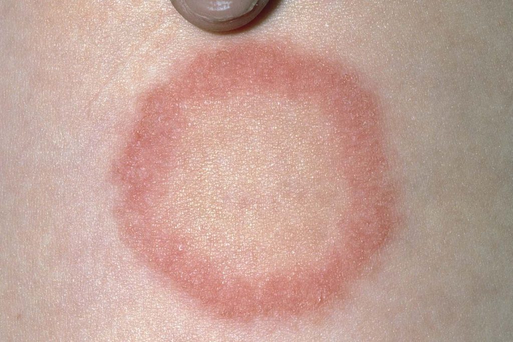 Closeup Outbreak Herpes On Human Skin Stock Photo 1109431940 | Shutterstock