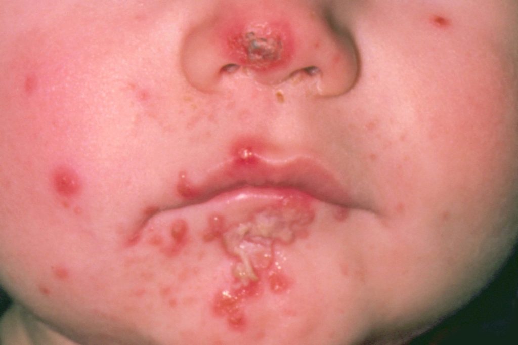 impetigo