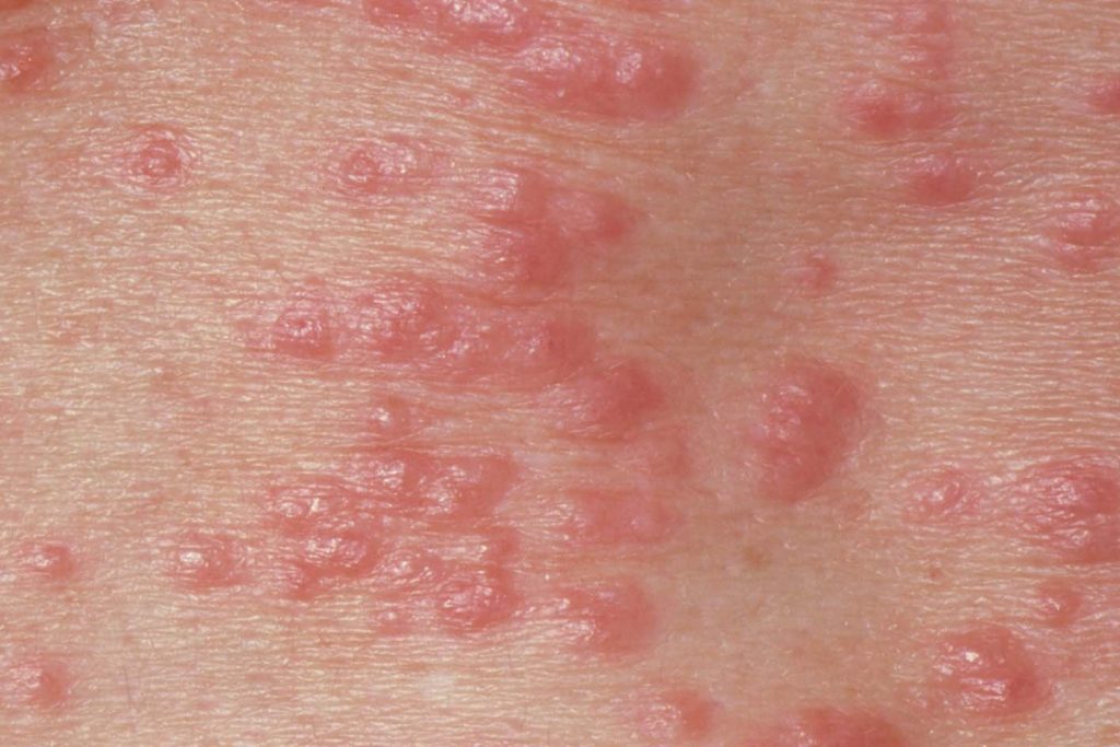 Scabies image