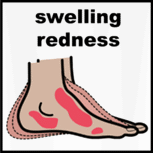 Swelling and redness in feet